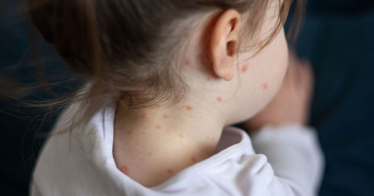 **Key Information on the Rising Measles Cases in London**