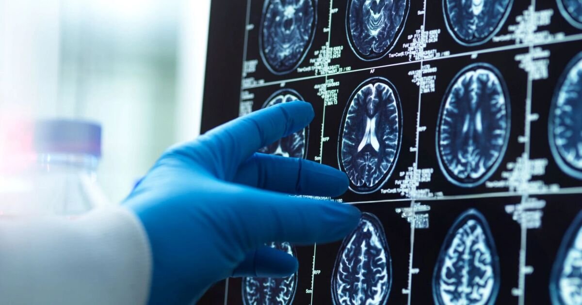 New Research Suggests Potential for Reversing Advanced Alzheimer's Disease