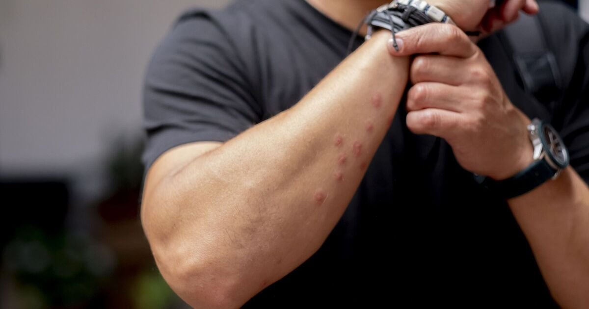 Hotel Guests Advised to Inspect Rooms for Bed Bugs Before Unpacking