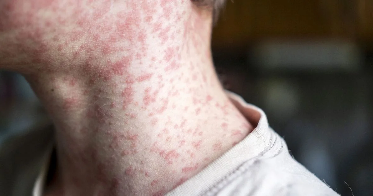 Surge in Measles Cases Sparks Urgent Vaccination Campaign in England