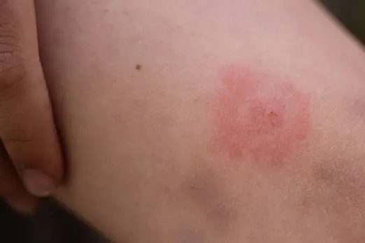 UK Health Security Agency Warns of Rising Cases of Rhabdomyolysis in England and Emphasizes Early Symptom Recognition