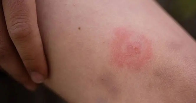UK Health Security Agency Warns of Rising Cases of Rhabdomyolysis in England and Emphasizes Early Symptom Recognition