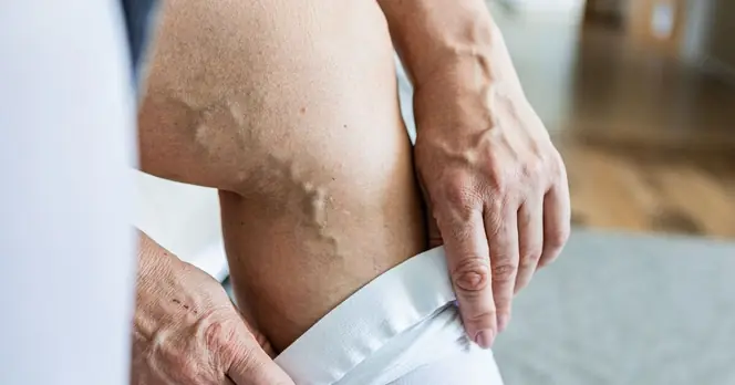 **Health Experts Warn One in Three Brits with Common Condition to Take Precautions in Summer Heat**