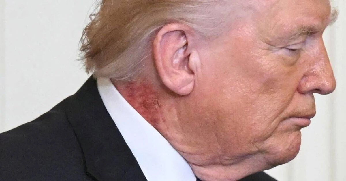 Donald Trump's Health Under Scrutiny Following Neck Rash Appearance