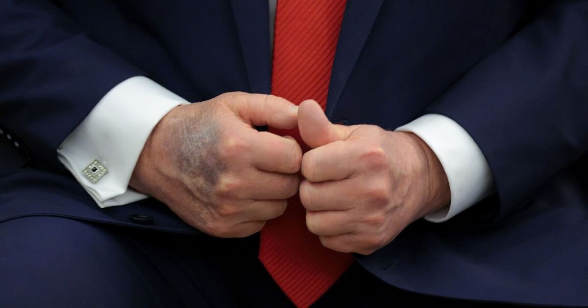 Donald Trump Addresses Dark Spots on Hand Following Speculation