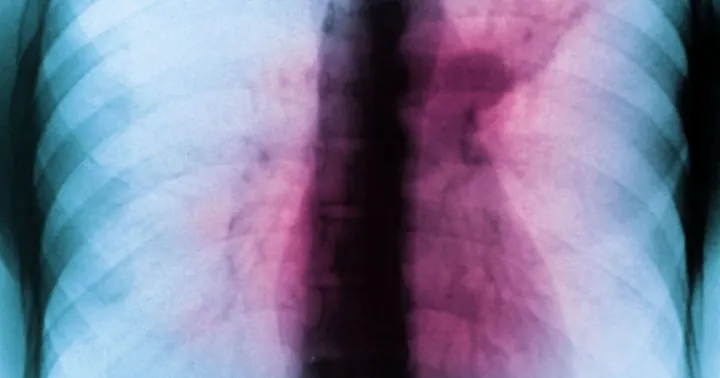 Drug-resistant Tuberculosis Remains Undetected in One in Five Cases Across Europe