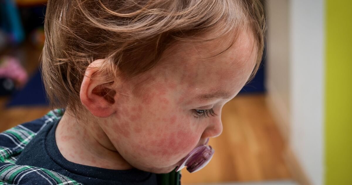 NHS Issues Guidance on Measles Prevention Amid Rising Cases in the UK