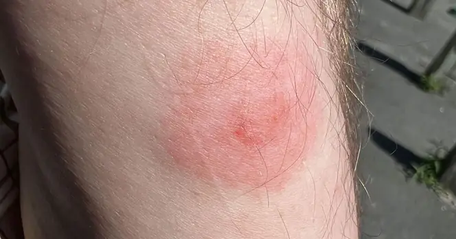 Health Officials Warn of Increased Tick-Borne Infection Risk in Summer 2026 Due to Warmer Weather and Rainfall