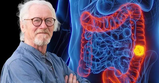 Innovative Immunotherapy Treatment Shows Promising Results in Stage 3 Bowel Cancer Recovery