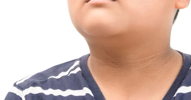 Skin Changes in Children Could Indicate Risk of Diabetes Associated with Obesity