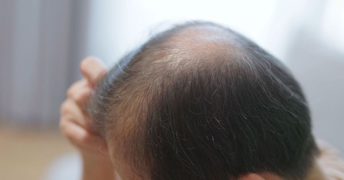 Smoking Linked to Early Hair Loss Among Millions of Britons