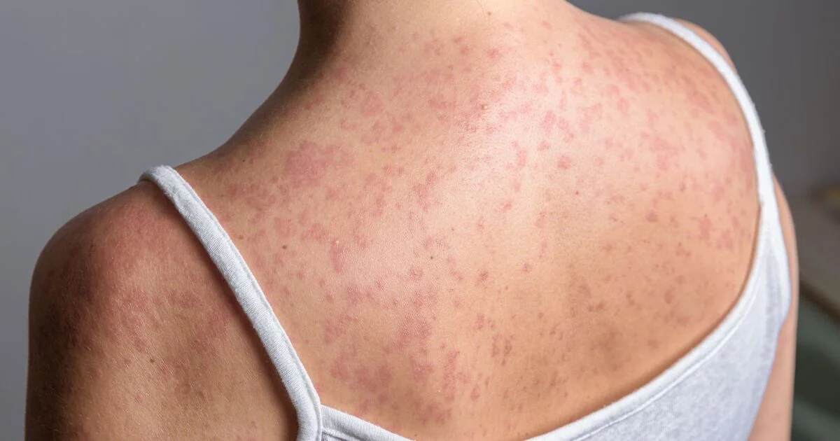 Outbreak of Victorian-Era Disease Confirmed in 50 UK Areas, Prompting Health Warnings