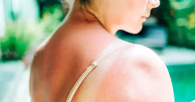 **Skin Cancer Cases Surge: Know the Warning Signs and When to See Your GP**