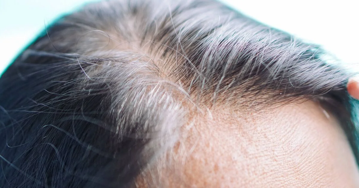 Thinning Hair May Indicate Biotin Deficiency, Experts Warn