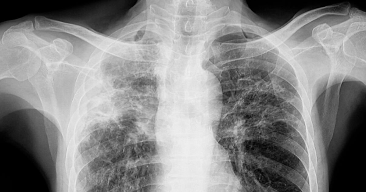 Rising Incidence of Tuberculosis in the UK Highlights Ongoing Public Health Challenge