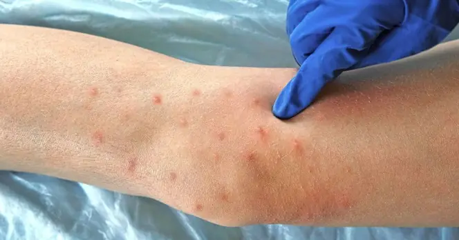 Common Causes and Symptoms of Rashes in Children: A Guide for Parents