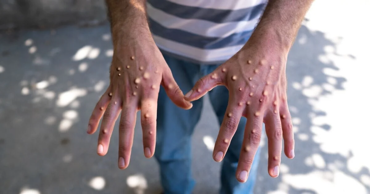 **Health Authorities Warn of Increased Mpox Cases in London and North West England**
