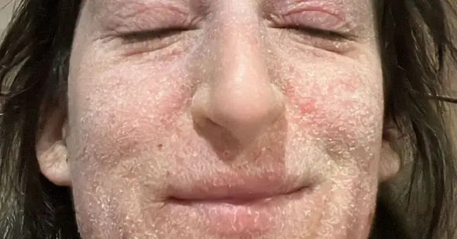 Woman Reflects on 28 Years of Eczema Cream Use and Its Effects on Her Skin Health
